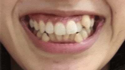 歯並びビフォーアフター