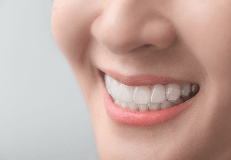 透明なマウスピースは目立たない